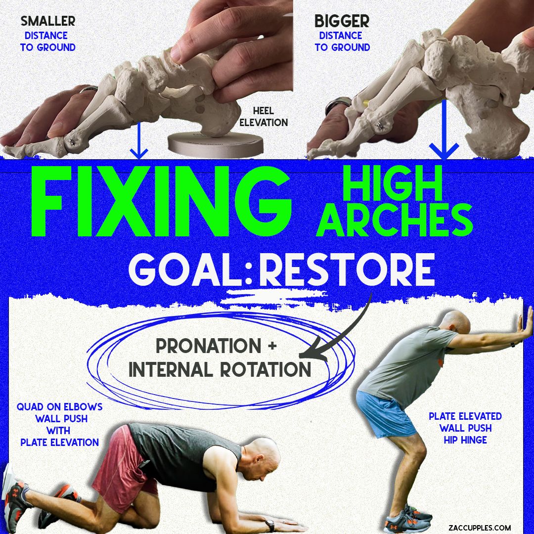 Toes Rotation Exercise I FIXED Toe Walking/Vaulting Gait with 2 Exercises – ZacCupples.com