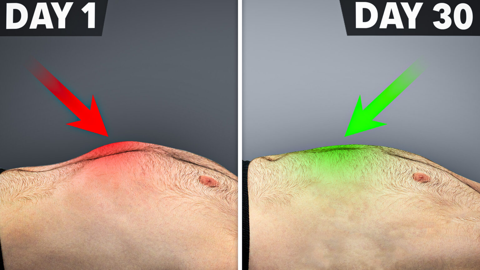 Pronated Rib Fix 90% of Rib Problems (Rib Flare, Humps, Posture, & More ...